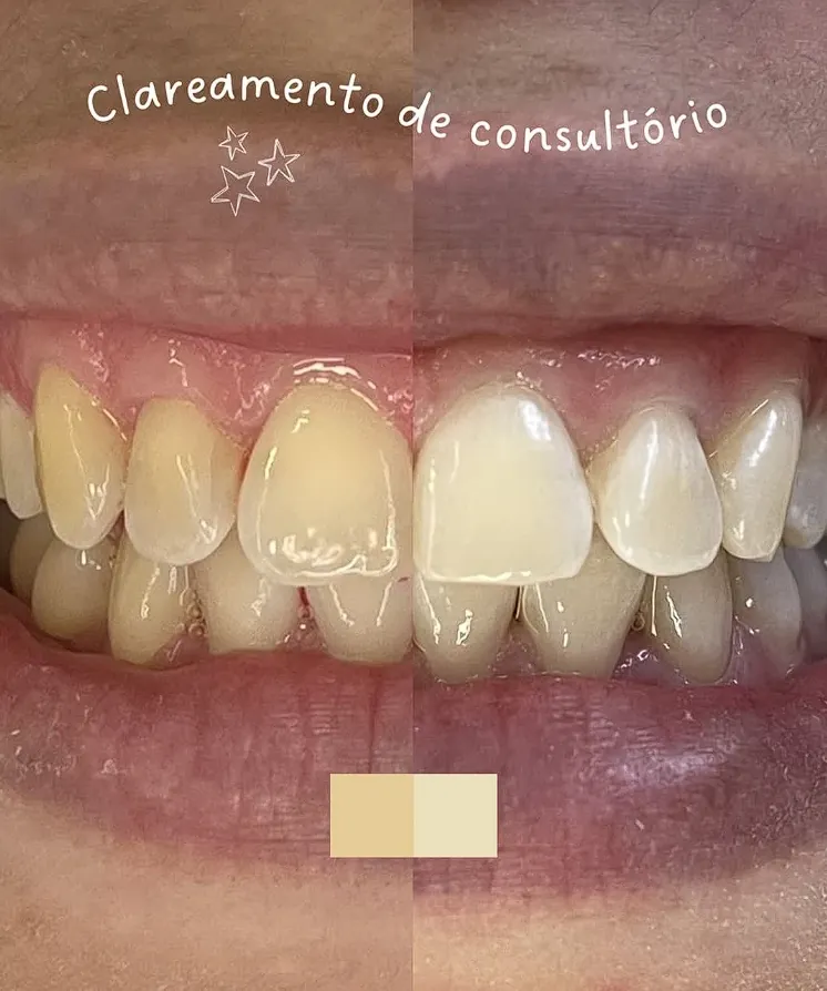 Clareamento de consultório