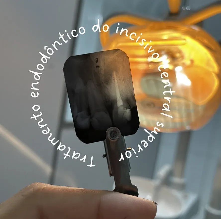 Radiografia de tratamento de canal